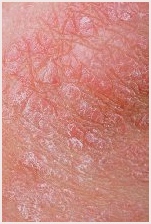 A Guide to Scabies Treatment Over The Counter Medications Available